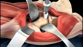 Hip replacement surgery techniques  Dr Scott Devinney [upl. by Ainesell]