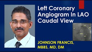 Left Coronary Angiogram In LAO Caudal View [upl. by Manolo592]