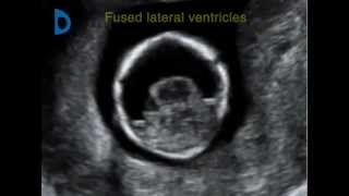 Fetal Medicine Foundation  alobar holoprosencephaly 12 weeks [upl. by Noicpesnoc]