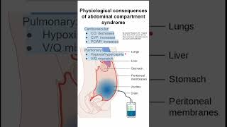 DNS Intra Abdominal Pressure [upl. by Eehtomit975]