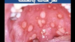 متلازمة بهجت للدكتور فهيد السبيعي BEHCETS DISEASE DRFOHEID ALSOBEI [upl. by Cly]