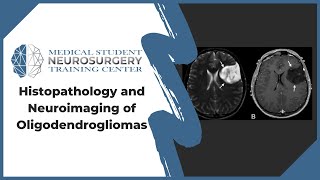 Histopathology and Neuroimaging of Oligodendrogliomas [upl. by Abner]