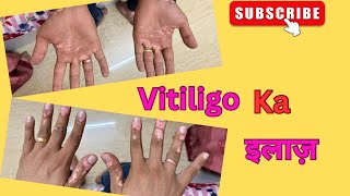 Vitiligo ka treatment Ke liye Gaya harshvlogs vlogs vitiligotreatment [upl. by Acinomahs585]