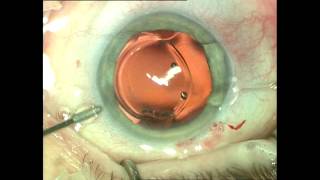 Previous LASIK for Hyperopia Cataract Surgery amp Intraocular Lens Implant [upl. by Ahtelat]