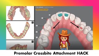 Invisalign ClinCheck  Attachment HACK to Correct a Premolar Crossbite [upl. by Nairda165]