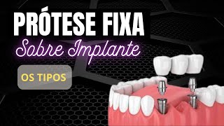 PROTESE FIXA SOBRE IMPLANTES  TODOS OS TIPOS [upl. by Ekeiram]