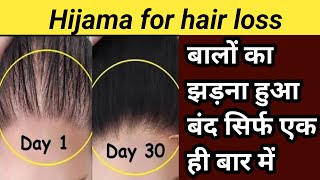 hijama for hair loss caping threpp for hair Maulana Sohel DHT hijama 2m 8805851816 [upl. by Yenruoc]