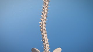 Adolescent Idiopathic Scoliosis  Carolina Neurosurgery amp Spine Associates [upl. by Ahpla]