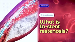 What is Instent restenosis [upl. by Vaughn]