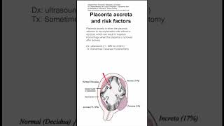 Placenta accreta and risk factors [upl. by Lavro922]