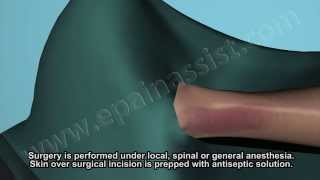 Ankle Fracture Surgery Watch How Fractured Ankle Is Treated Surgically [upl. by Moise]