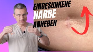 Eingesunkene Narbe nach OP behandeln Dr Kasten Hautmedizin in Mainz [upl. by Imled]