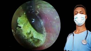 🔴big dry ear wax and dead skin removal transformation earearwax earwaxremovalearwaxcleaningasmr [upl. by Priscella983]