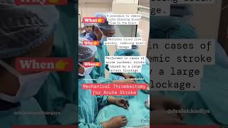 Mechanical Thrombectomy for acutestroke ytshorts interventionalneuroradiologist dralokkudiya [upl. by Arretal]