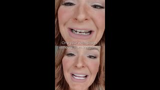 one year with clip in veneers from instasmile [upl. by Willin]