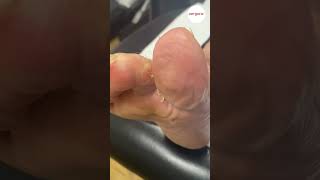 Hard skin forms between toes debrided by podiatrist [upl. by Otanod]