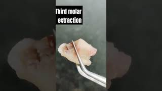 Third molar extraction wisdomtoothremoval extraction [upl. by Marquet]