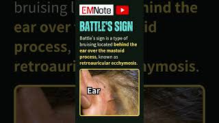 Battles Sign Retroauricular Ecchymosis [upl. by Tnayrb]