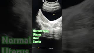 Normal pelvic scan ultrasound doctor usg uterus ovary cervix [upl. by Isnam]