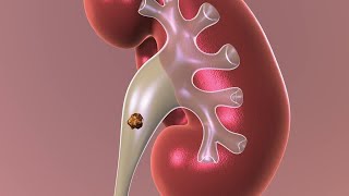 Observation Nonsurgical Approach to Kidney Stones [upl. by Iz]