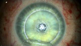 Stephen Slade MD Presbyopia Surgery for Patients Who Need Reading Glasses [upl. by Aribold]