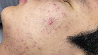 ACNE TREATMENT VU QUYNH MI  Blackheads Of Tweens 2024 EX [upl. by Hardej]