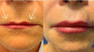 How to Get Rid of Wrinkles around Lips💋How to Get Plump LipsBiggerLipsFuller Lips [upl. by Tabbi]