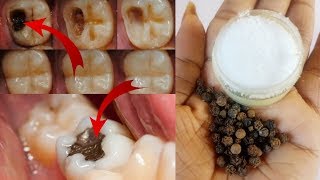 Cure tooth cavity just in one day  100 effective remedy for tooth ache  tooth pain home remedy [upl. by Kunkle423]