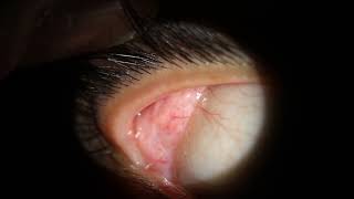 Dacryoadenitis Swollen Lacrimal Tear Gland  comes out of eye at 037 [upl. by Maag]