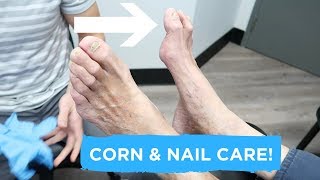 Apical Heloma Durum Treatment  Corn and Nail Care [upl. by Nacul]