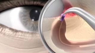 Punctum plug procedure  animation [upl. by Asenab430]