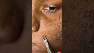 Trimming dead skin  Chemical Peel  Hyperpigmentation Removal [upl. by Vaughan902]