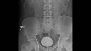 CASE 395 intravenous pyelography IVP left renal agenesis [upl. by Israeli]