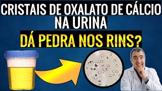 CRISTAIS DE OXALATO DE CÁLCIO na urina aumentam a chance de ter pedras nos rins [upl. by Nerine]