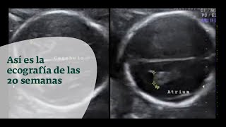 ECOGRAFÍA SEMANA 20 ⏰ MORFOLÓGICA ÓRGANOS 🧠 MALFORMACIONES    Ginecología y Obstetricia [upl. by Leeda227]