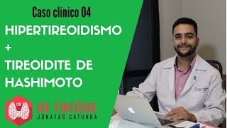 Hipertireoidismo causado por Tireoidite de Hashimoto  Caso clínico 04  Dr Jônatas Catunda [upl. by Ahtela]