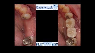 Flapless Dental Implant surgery with R2GATE [upl. by Oninotna]