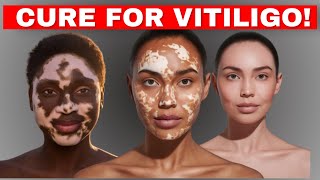 Vitiligo Skin Disease Treatment CausesTreatments  Home Remedies to cure Vitiligo Fast [upl. by Arremat]