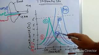 Tympanometry Impedance Audiometry [upl. by Florentia45]