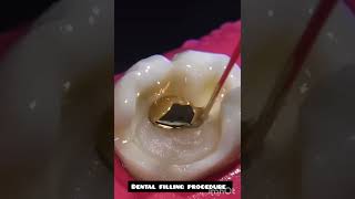 dentalclinic dental filling procedure [upl. by Oneil381]