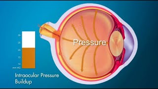 The mechanisms of optic nerve damage [upl. by Cordie]