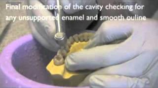 PRD approximal posterior amalgam part 1 of 2 [upl. by Bresee]