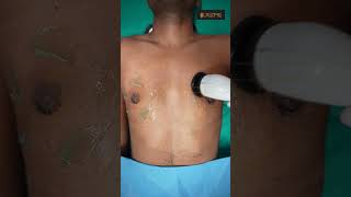 Gynecomastia cure  Dressing removal amp RF Session shorts [upl. by Mroz]