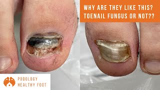 Why are these TOENAILS SUPER THICK AND DISCOLORED Toenail fungus or not [upl. by Encratia921]