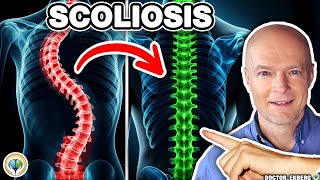 Scoliosis Treatment Without Surgery Or A Brace Scoliosis Pain Relief [upl. by Seften253]