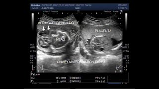 Chiari type 3 malformation with Meningoencephalocele [upl. by Nylarad]