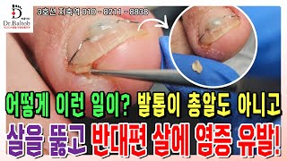 🔨파고드는 발톱🔨 발톱이 밑으로 깊이 파고 들어가 반대편 살에 염증과 딱지 유발 😣 발톱닥터 내성발톱 내성발톱교정 내성발톱관리 지축역 [upl. by Carmita]