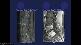 Spine Imaging  Spine Infection Tips For Radiologists [upl. by Bonnes]