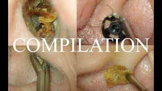 4 CASES  SEVERE EAR  COUGH REFLEX  CERUMEN IMPACTION  FOREIGN BODY  SYNDROMIC EARS [upl. by Drislane670]