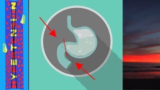 Pyloric Stenosis and Metabolic Alkalosis [upl. by Wiles]